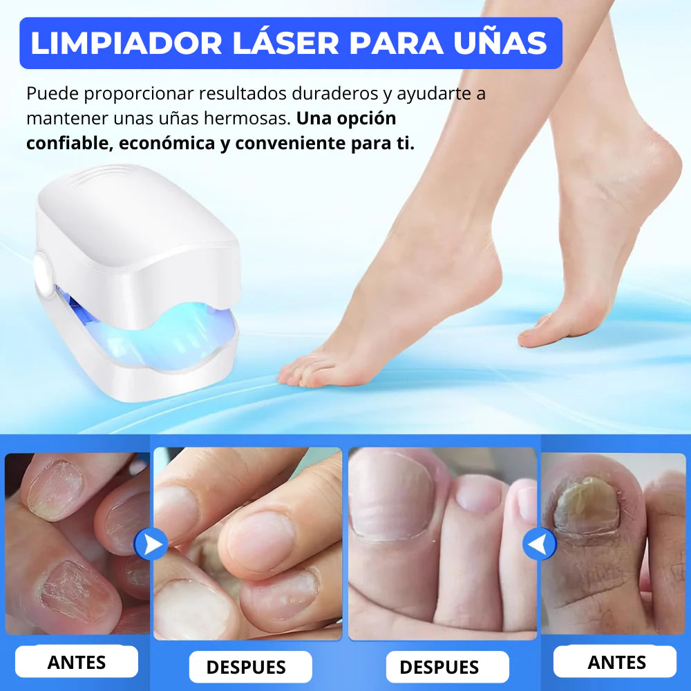 Láser para Uñas Antihongos – Elimina Hongos y Recupera la Salud de tus Uñas